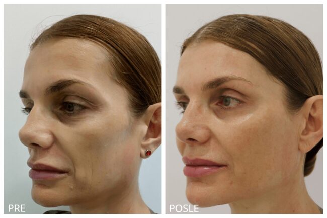 Hijaluron pre i posle 1a