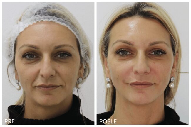 Hijaluron pre i posle