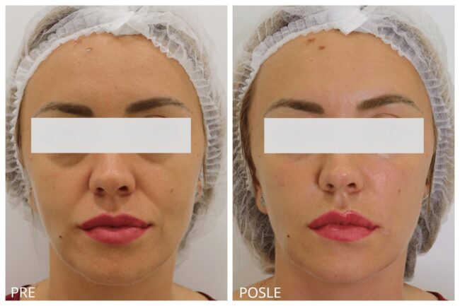 Hijaluron pre i posle 8