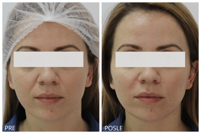 Hijaluron pre i posle 9