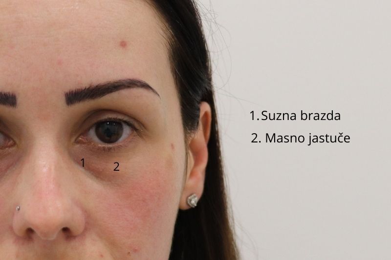 Suzna brazda tear trough Tamni kolutovi oko očiju