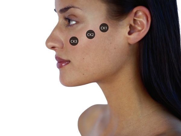 jagodice hijaluron mdkodovi cheekbone augmentation