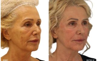 Skin and face rejuvenation after 60. years