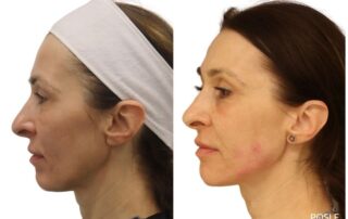 Podmlađivanje kože i lica nakon 50. godine