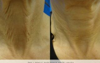 neck rejuvenation clearskin