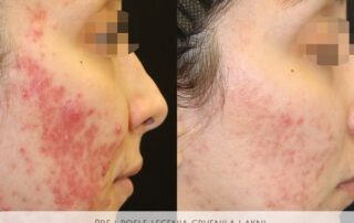 clearskin acne treatment