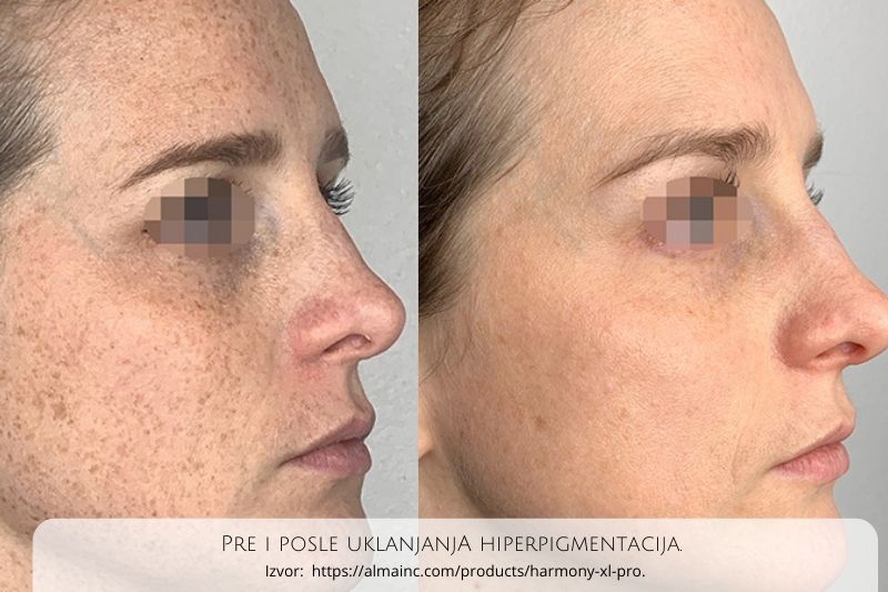 alma harmony xl pro pre i posle hyperpigmentation