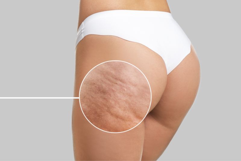 celulit anticelulit cellulite anticellulite