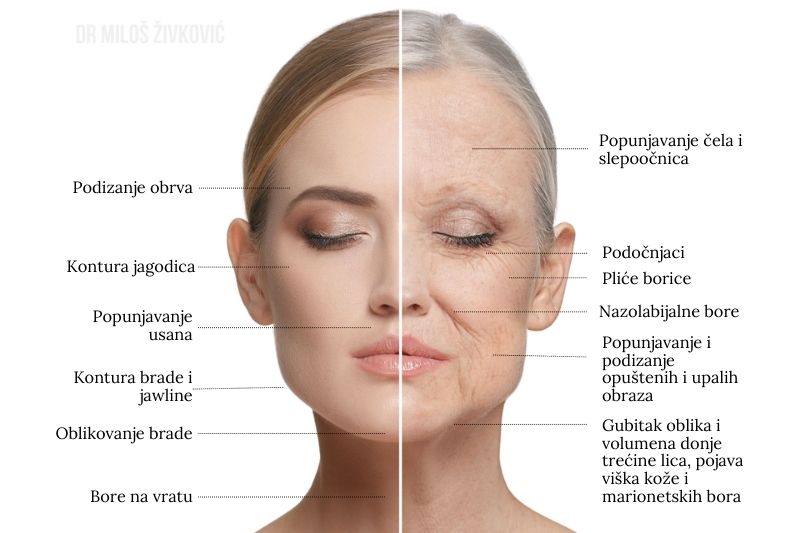 hijaluronski fileri bore hyaluronic fillers wrinkle