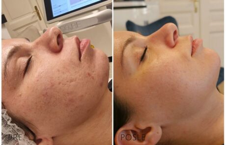 ožiljci od akni iskustvo pre i posle tretmana