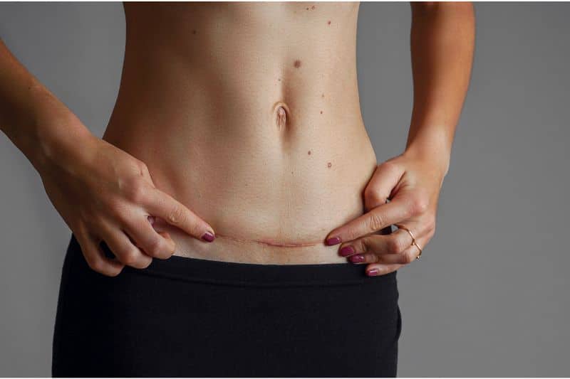 ožiljci od operacija abdominoplastika skinpen
