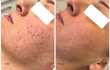 ožiljci od akni co2 laser