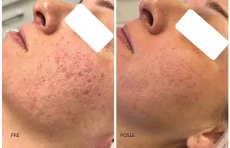 ožiljci od akni co2 laser
