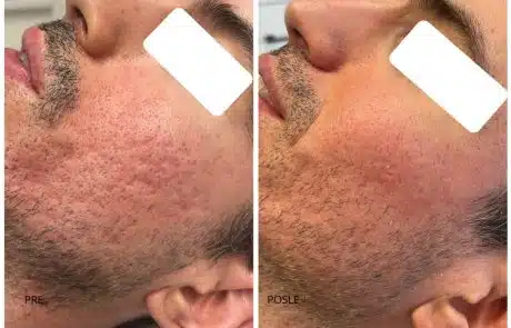 ožiljci od akni co2 laser subcizija