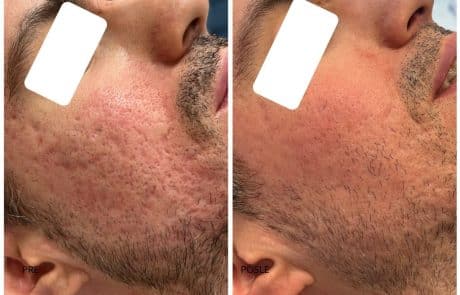 ožiljci od akni co2 laser subcizija