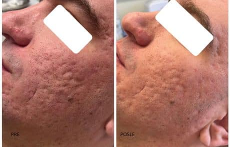 ožiljci od akni co2 laser subcizija