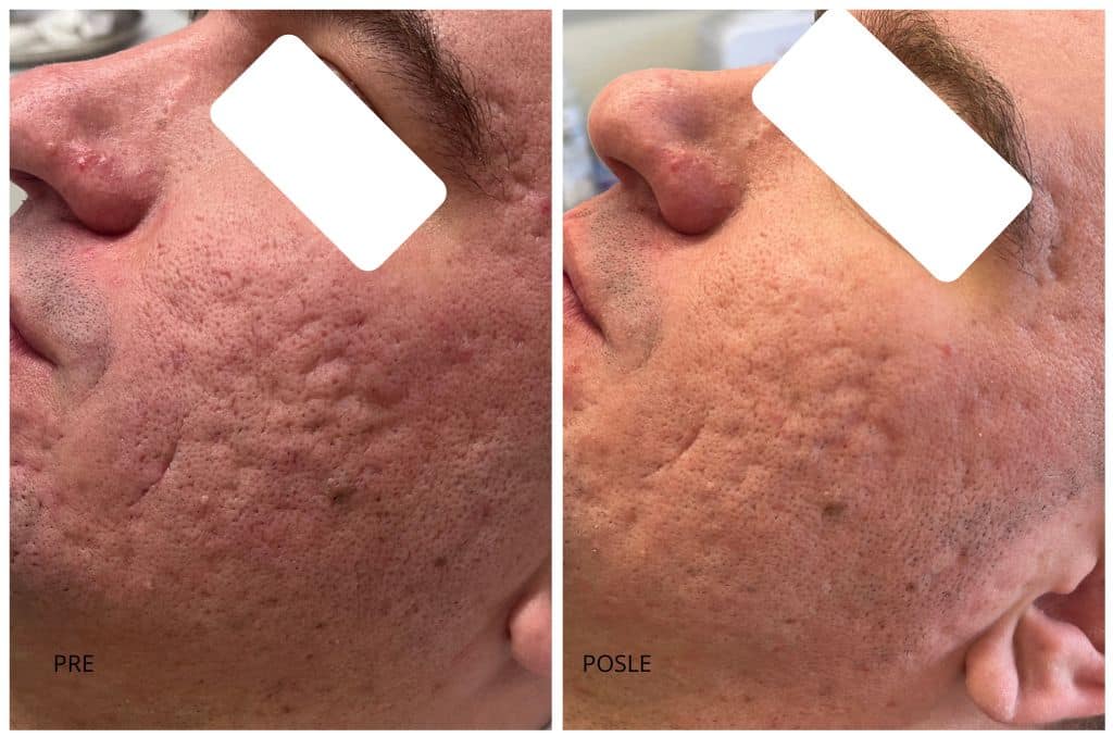 ožiljci od akni co2 laser subcizija