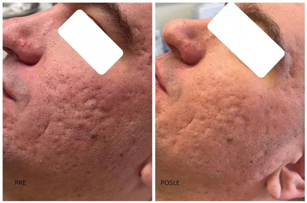 ožiljci od akni co2 laser subcizija