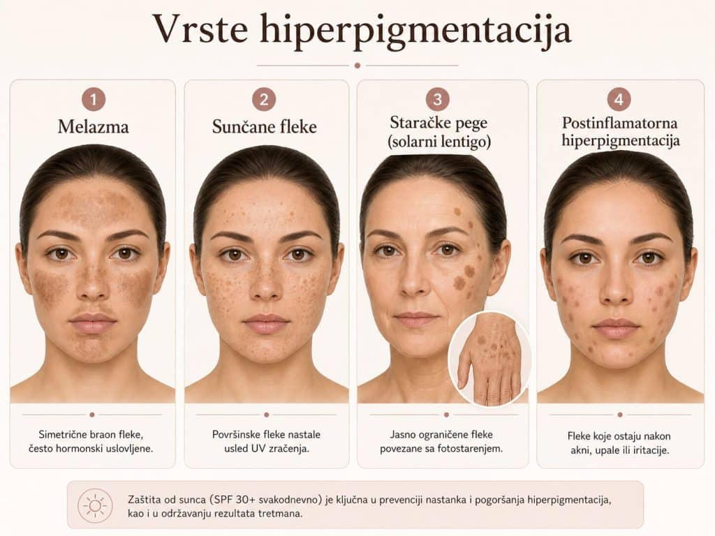 hiperpigmentacije vrest