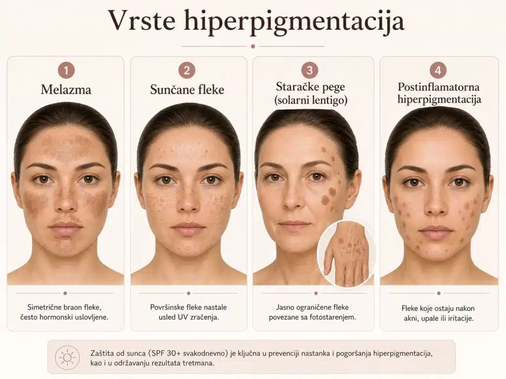 hiperpigmentacije vrest