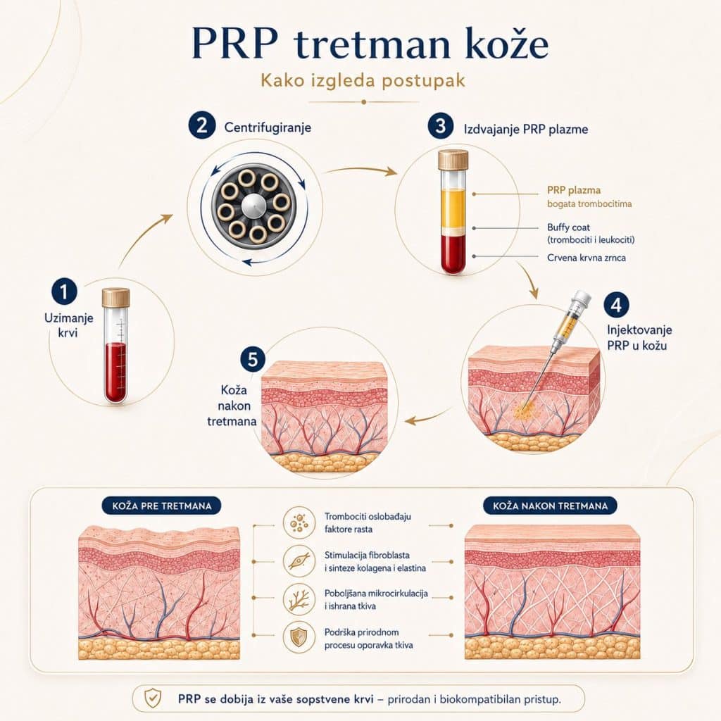 prp tretman beograd .