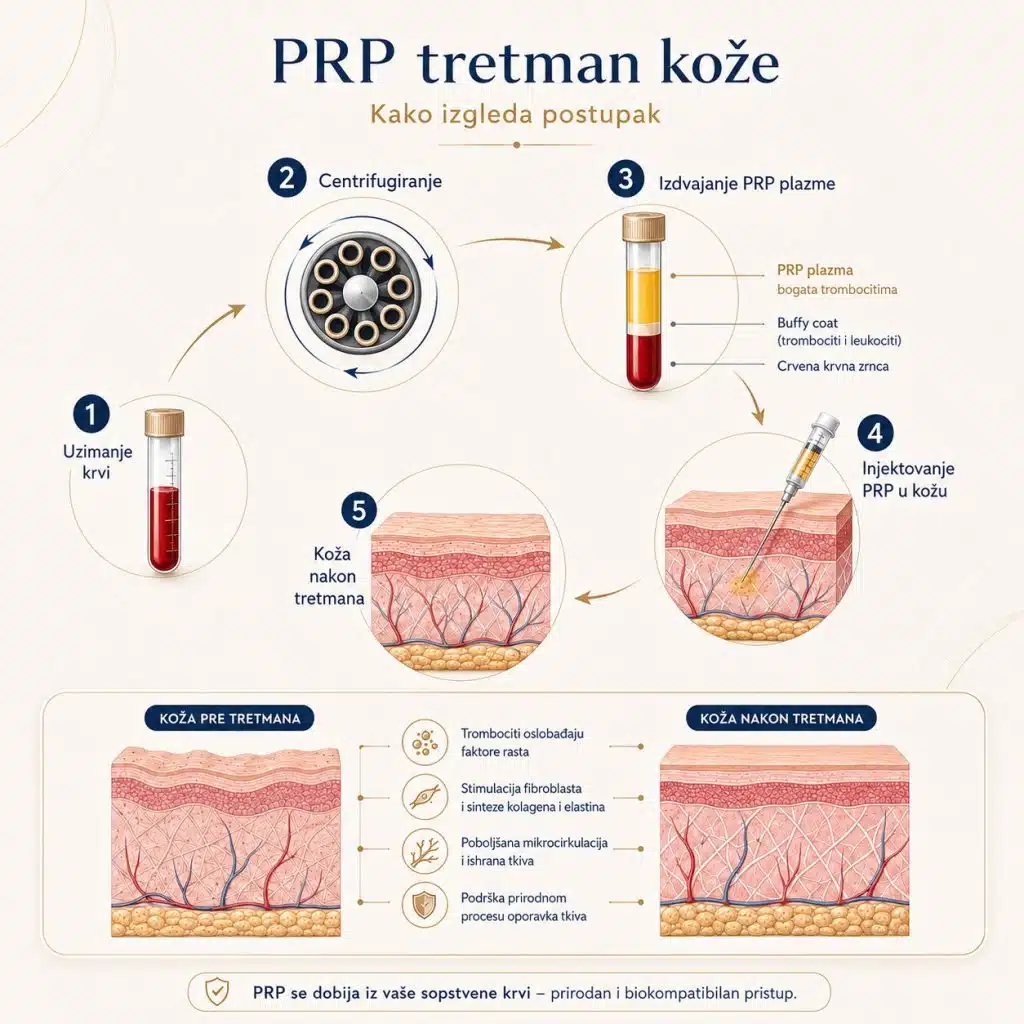 prp tretman beograd .